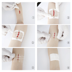 Pansement de sutures 7 x 6 cm